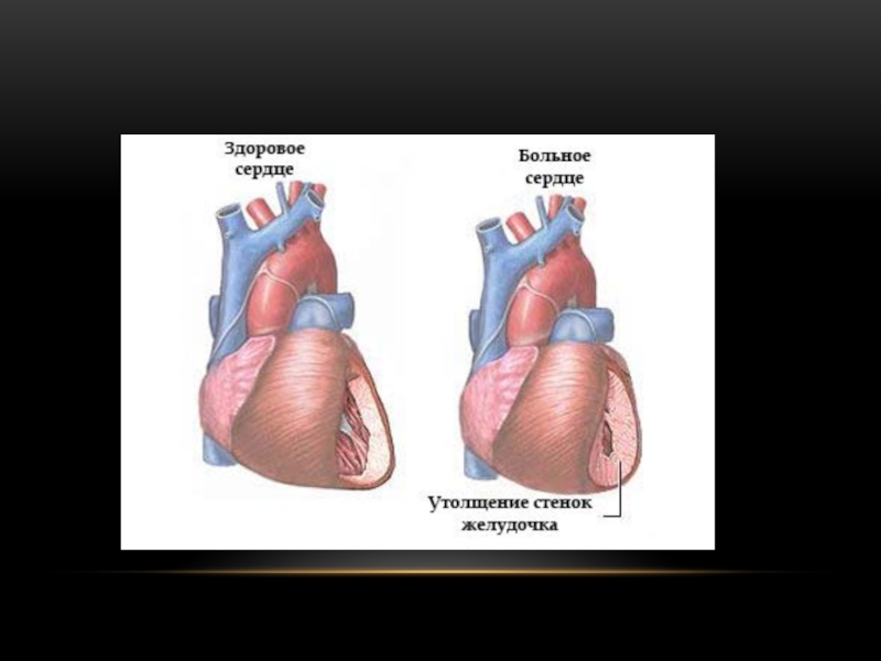 Утолщение стенок сердца. Здоровое и нездоровое сердце. Сердце здорового человека и нездорового. Утолщение сердечной стенки.