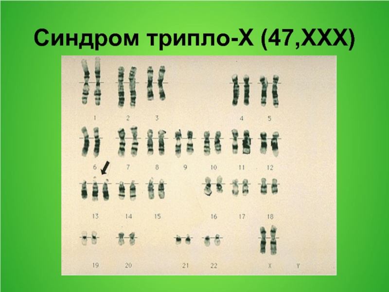 Фото трипло. Синдром трисомии х кариотип. Синдром трипло-х. Трипло х кариотип. Трисомия по х-хромосоме кариотип.