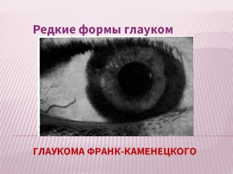 Глаукома Франк-Каменецкого. Редкие формы глауком
