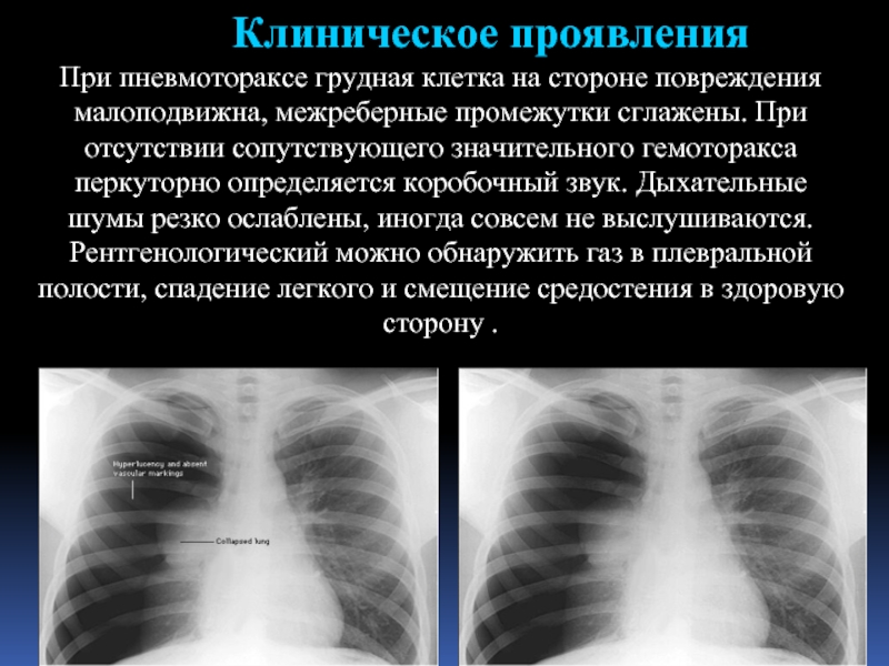 Изменения грудной. Пневмоторакс грудной клетки. Пневмоторакс при травме грудной клетки. Межреберные промежутки при пневмотораксе. Изменения грудной клетки при закрытом пневмотораксе.