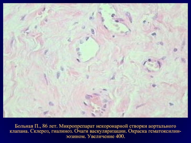 Гиалиноз относится к. Фибриноидное набухание микропрепарат. Остеопороз патанатомия микропрепарат. Гиалиноз соединительной ткани микропрепарат.