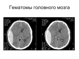 Гематомы головного мозга