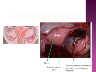 Apoplexy ovary