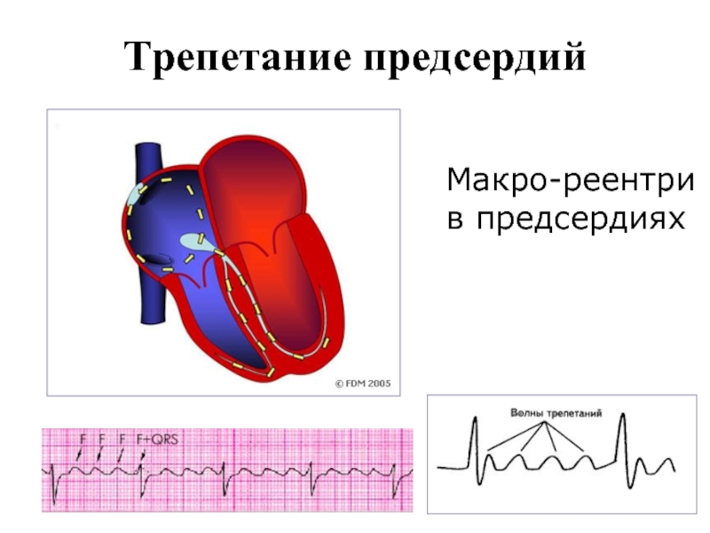 Трепетание предсердий причины