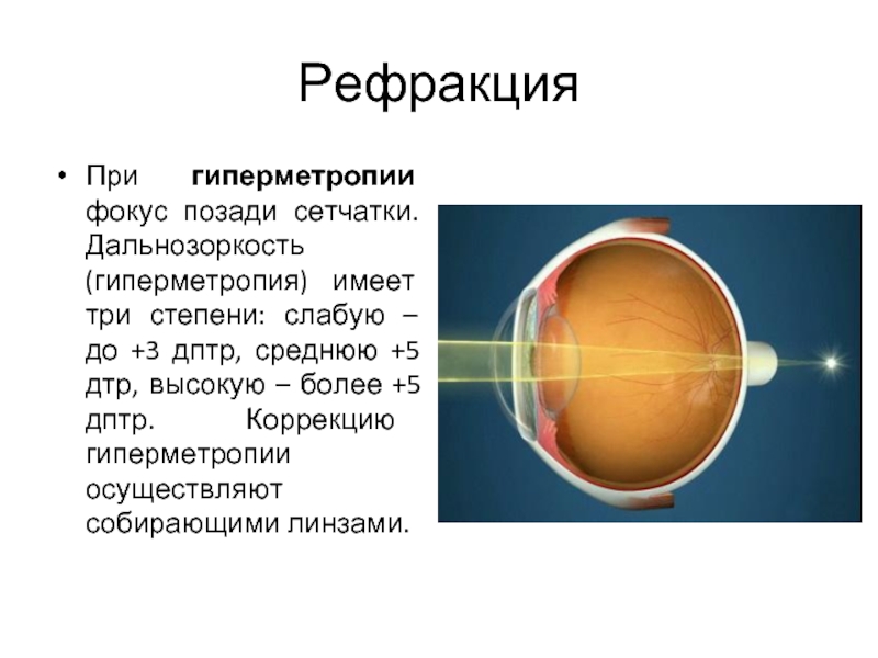 В близоруких глазах изображение фокусируется перед и позади сетчатки перед сетчаткой позади сетчатки