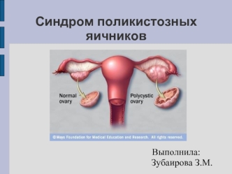 Синдром поликистозных яичников. Клиническая картина