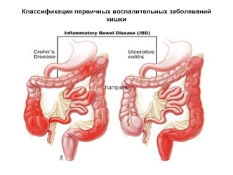 Классификация первичных воспалительных заболеваний кишки