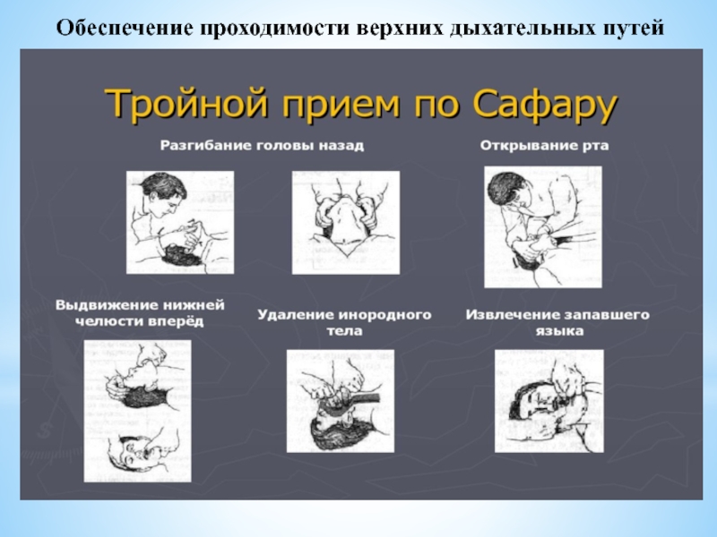 Как обеспечить проходимость дыхательных. Обеспечение проходимости ВДП. Обеспечение проводимости верхних дыхательных путей.. Обеспечение проходимости верхних дыхательных путей. Обеспечение проводимости ВДП.