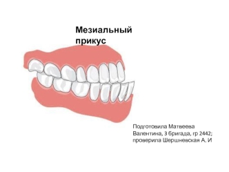 Мезиальный прикус