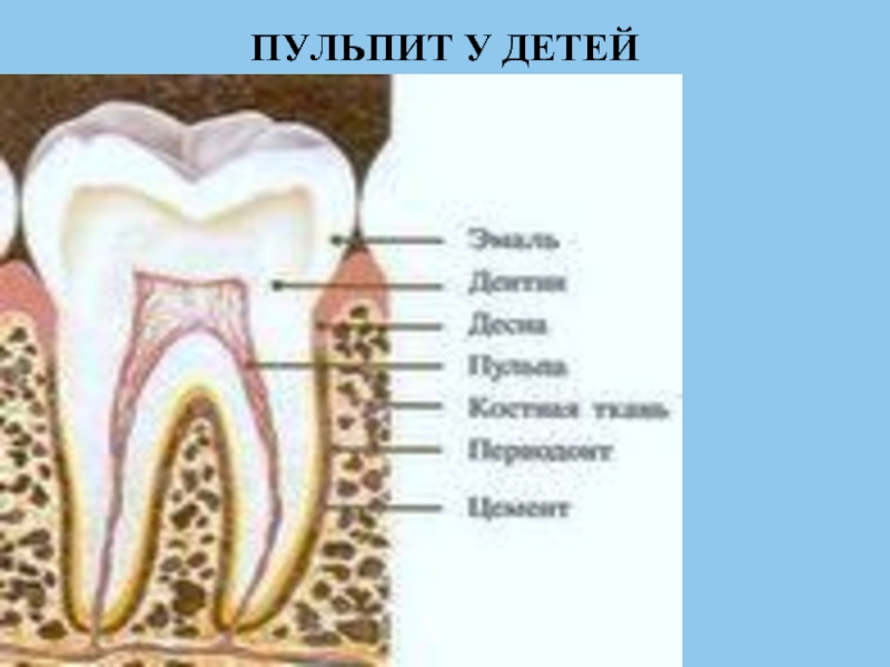 Пульпит зуба у детей как выглядит