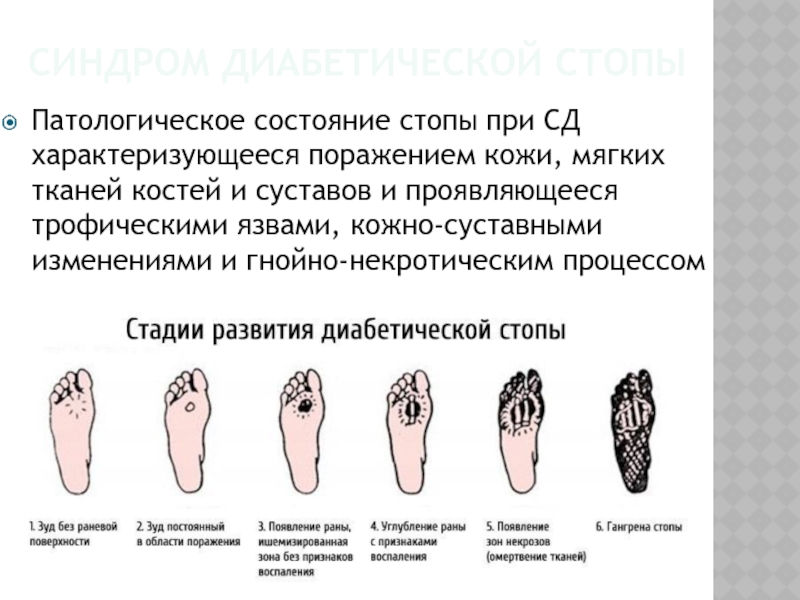 Гангрена конечностей код мкб. Диабетическая стопа гангрена пальца. Диабетическая стопа язва. Диабетическая стопа начальная стадия. Профилактика диабетической стопы.