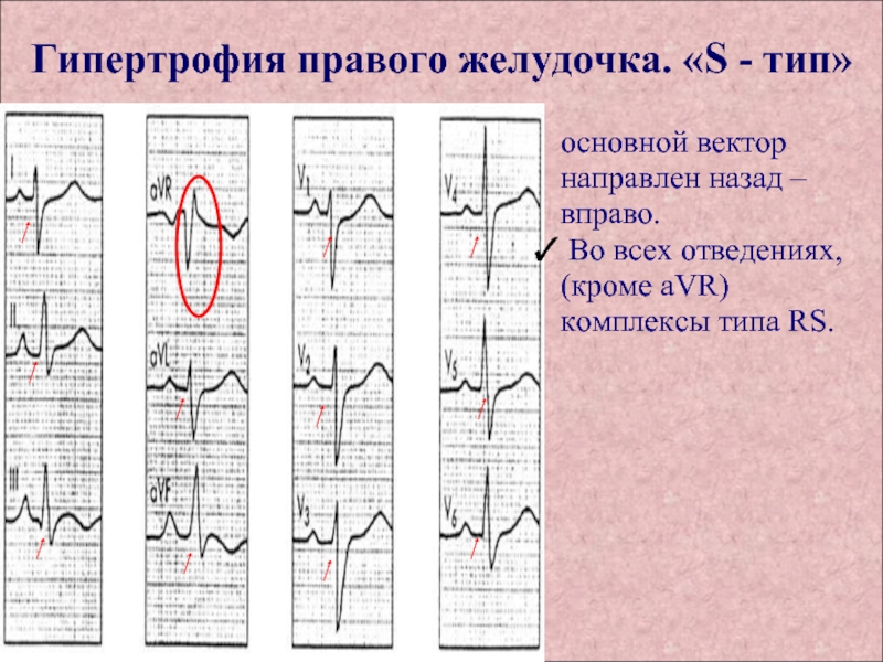 Признаки гипертрофии левого. Гипертрофия правого желудочка по ЭКГ. S Тип гипертрофии правого желудочка на ЭКГ. ЭКГ пленка с гипертрофией правого желудочка. Гипертрофия миокарда правого желудочка на ЭКГ.