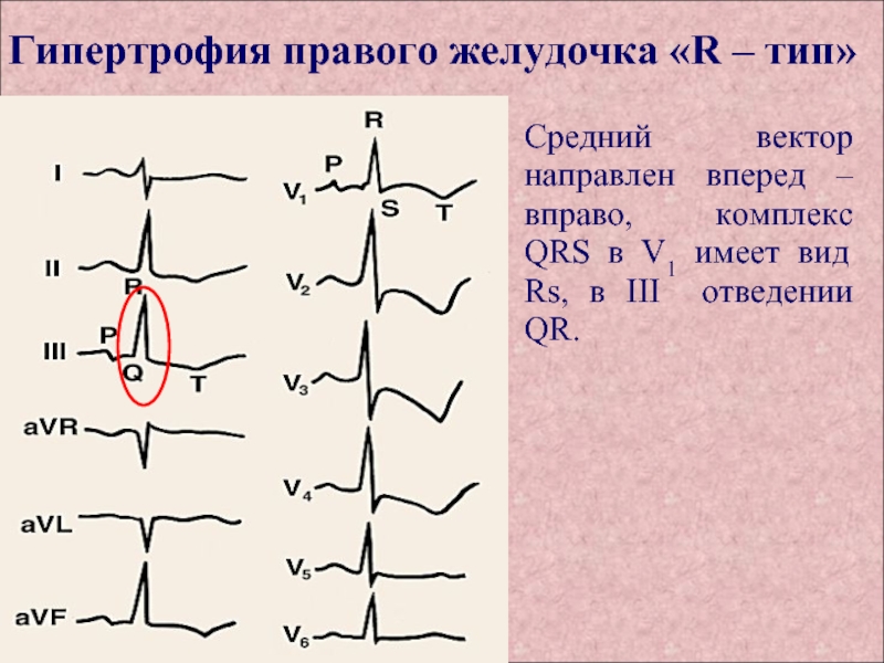 Поворот сердца правым желудочком вперед что это. Типы гипертрофии правого желудочка на ЭКГ. Гипертрофия правого желудочка r Тип s Тип.