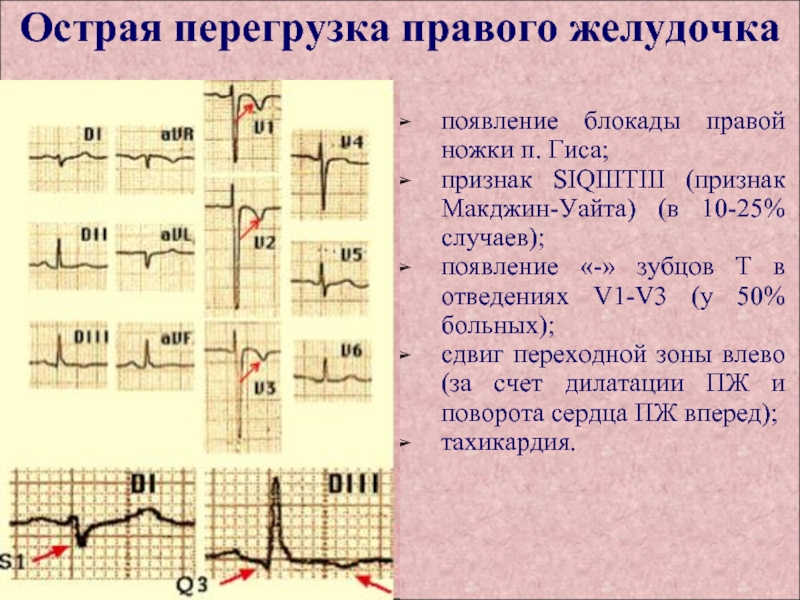 Диастолическая перегрузка левого желудочка на экг картинка