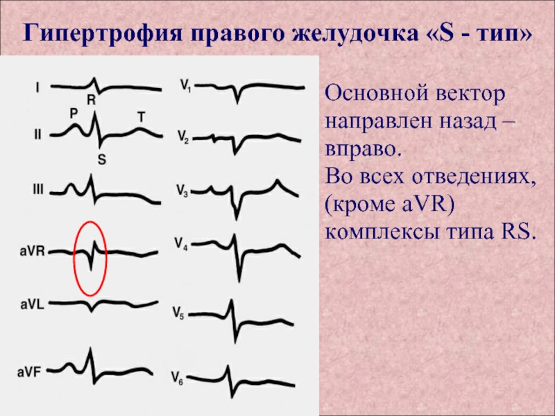 Гипертрофия правого