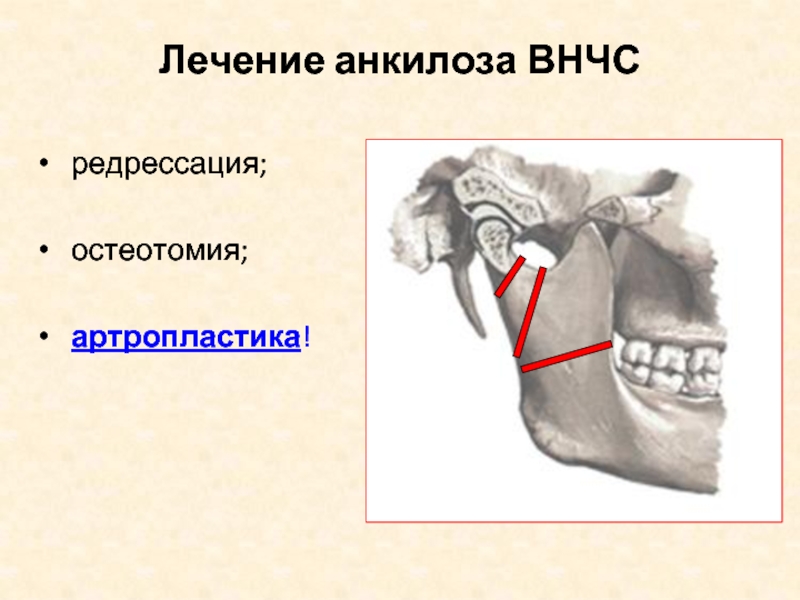 Анкилоз нижний