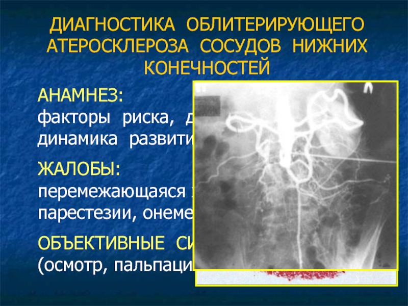 Атеросклероз артерий нижних конечностей код мкб