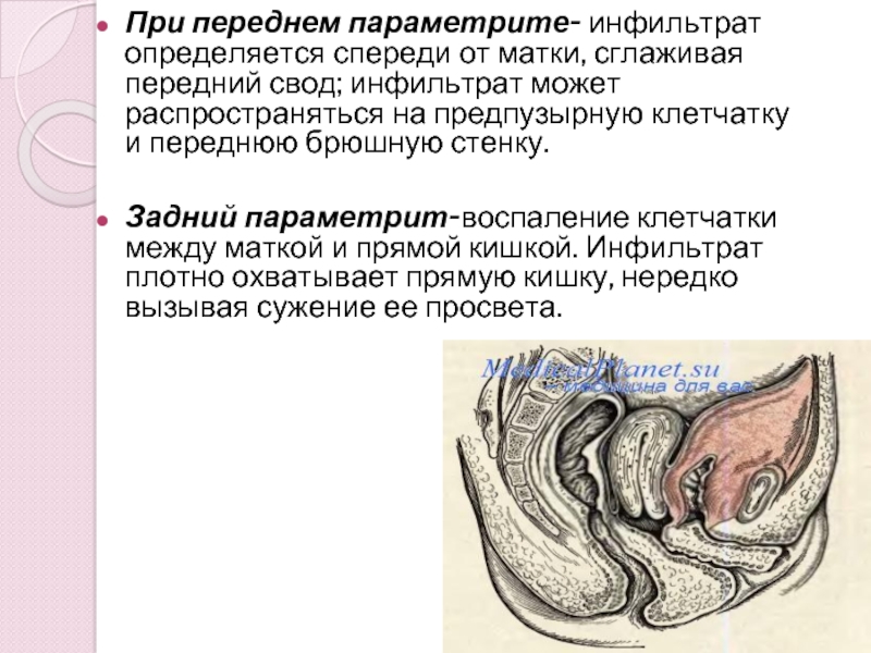 Послеродовый параметрит презентация