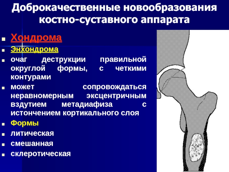 Доброкачественные опухоли костей презентация