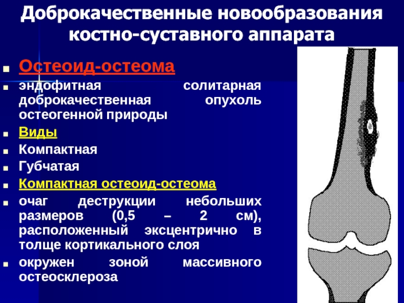 Очаги остеосклероза в костях