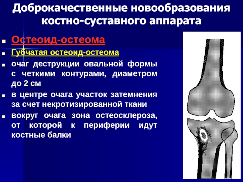 Остеоид остеома бедренной кости