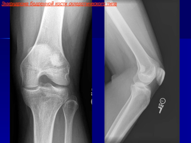 Экхондрома рентгенологическая картина