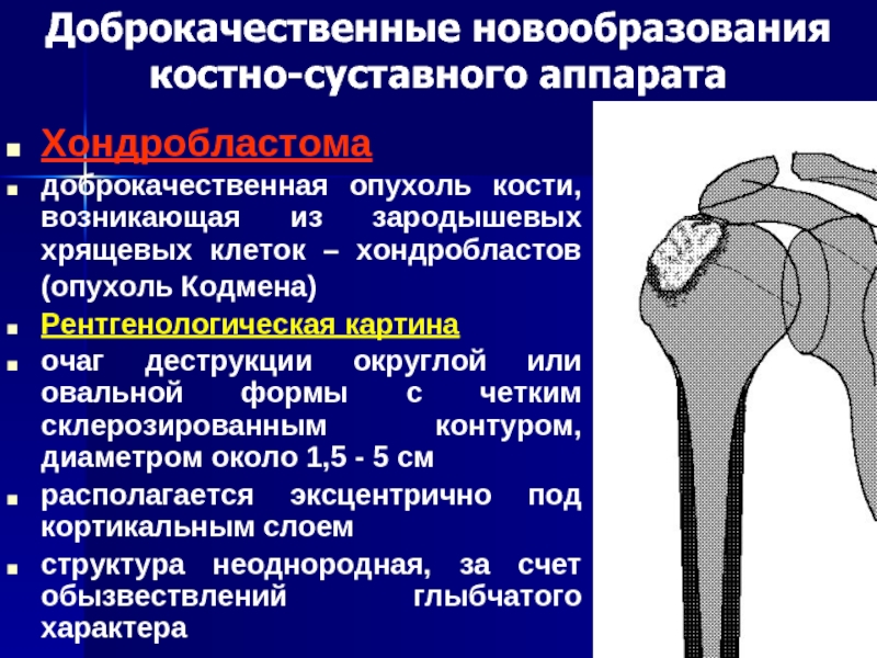 Опухоли костей. Доброкачественные опухоли костей. Доброкачественные костные опухоли. Доброкачественные новообразования костей. Доброкачественное образование кости.