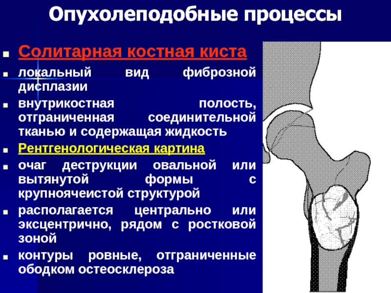 Для рентгенологической картины фолликулярной кисты характерна деструкция костной ткани в виде