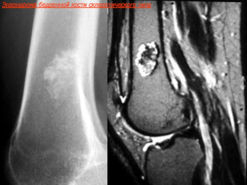 Энхондрома бедренной кости что это такое лечение фото