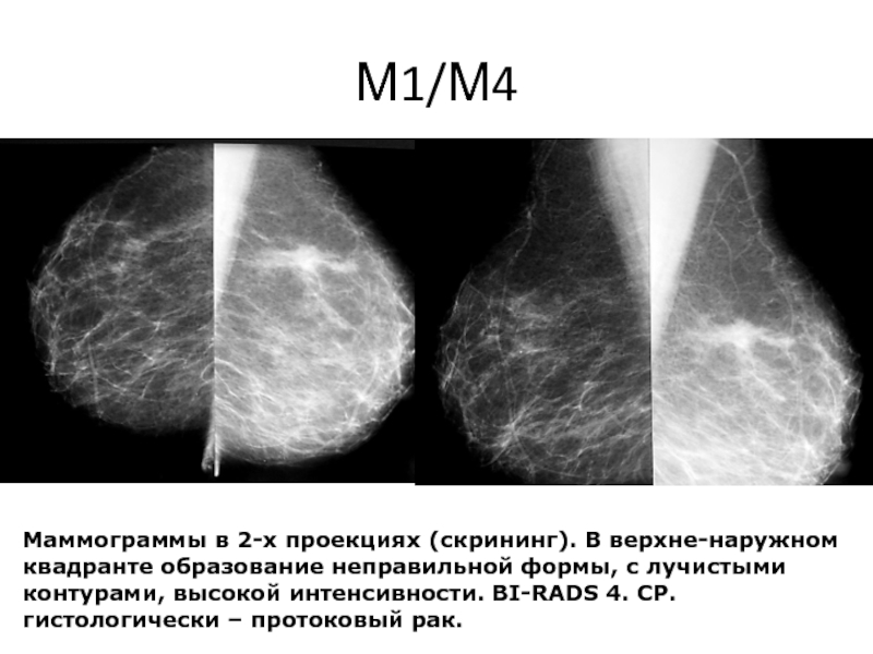 Результаты маммографии фото