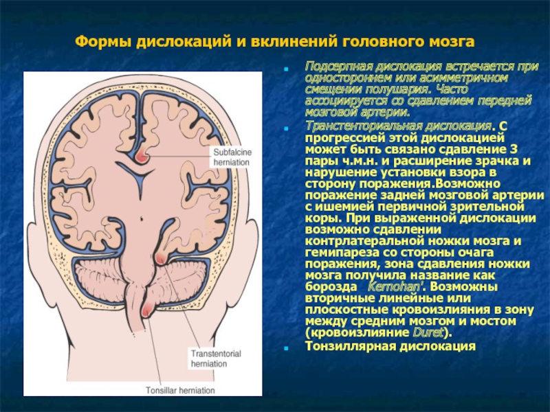 Оттек головного мозга. Транстенториальное вклинение головного мозга. Отек головного мозга с вклинением. Отек дислокация головного мозга.