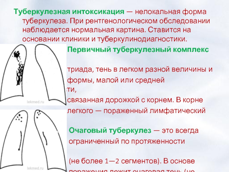 Туберкулезная палочка признаки. Туберкулезная интоксикация презентация. Первичный туберкулезный комплекс презентация.