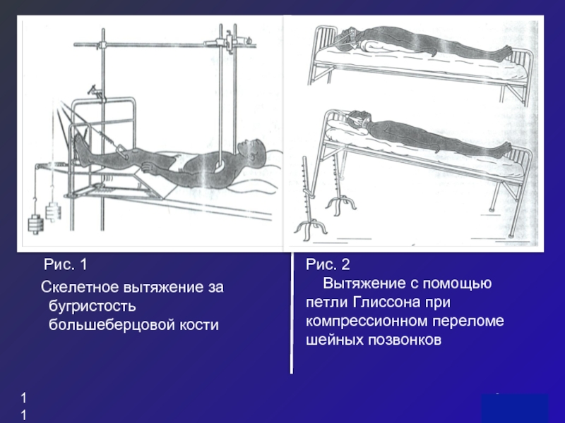 Скелетное вытяжение голени