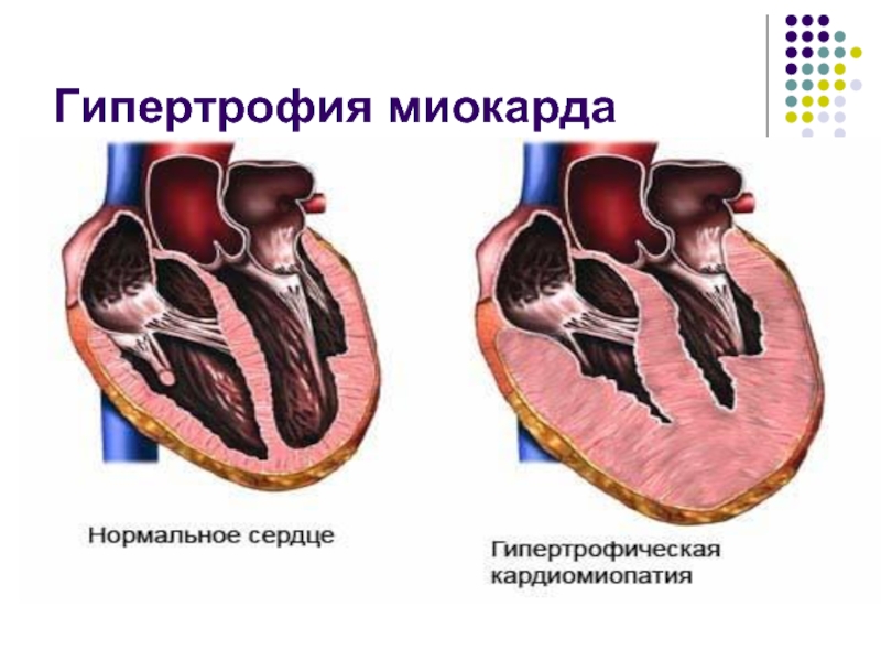 Гипертрофия сердца