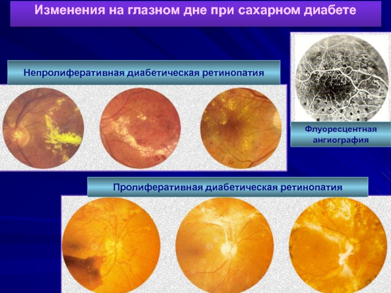 Изменение на глазном дне. Непролиферативная диабетическая ретинопатия. Диабетическая ретинопатия глазное дно. Диабетическая микроангиопатия, ретинопатия, нефропатия.. Патанатомия диабетической ретинопатии.