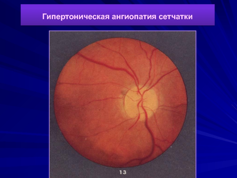 Изменение глазного дна при сахарном диабете презентация