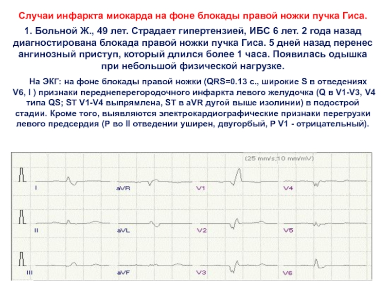 Пнпг что это значит у взрослого. Инфаркт миокарда при блокаде левой ножки пучка. Инфаркт миокарда на фоне блокады ножек пучка Гиса. Инфаркт миокарда на фоне блокады правой ножки пучка Гиса на ЭКГ. Инфаркт миокарда на фоне полной блокады правой ножки пучка Гиса.