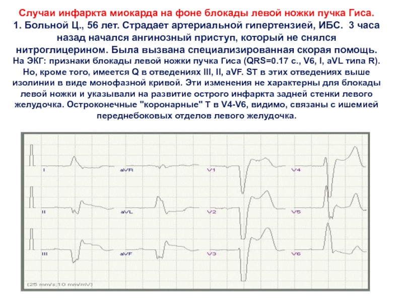 Блокада левого желудочка