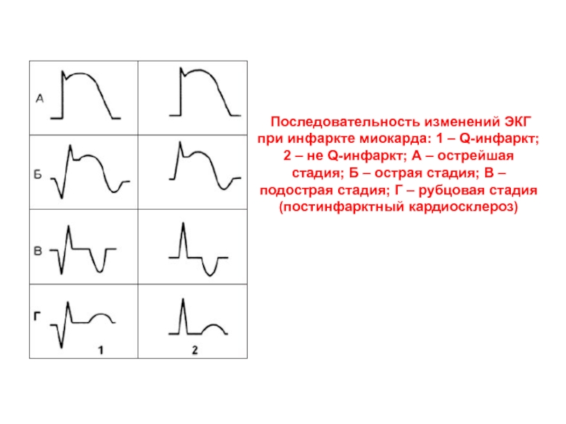 Что значит миокарда на экг. Нижний q инфаркт миокарда ЭКГ. Q инфаркт миокарда на ЭКГ. Инфаркт миокарда изменения на ЭКГ. Острый инфаркт миокарда ЭКГ схема.