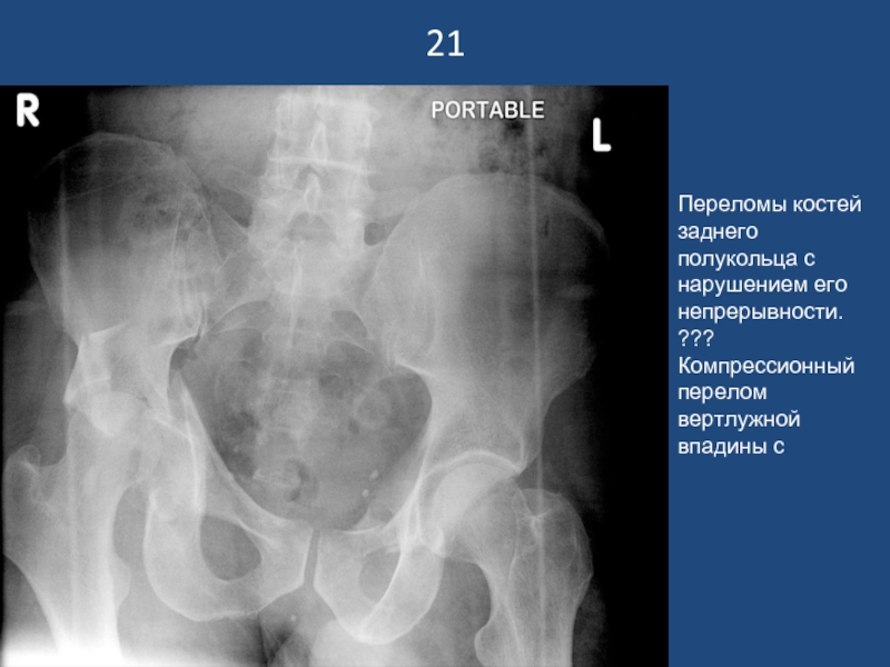 Перелом вертлужной впадины презентация