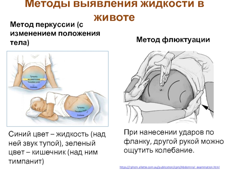 Острые процессы в брюшной полости у новорожденных презентация