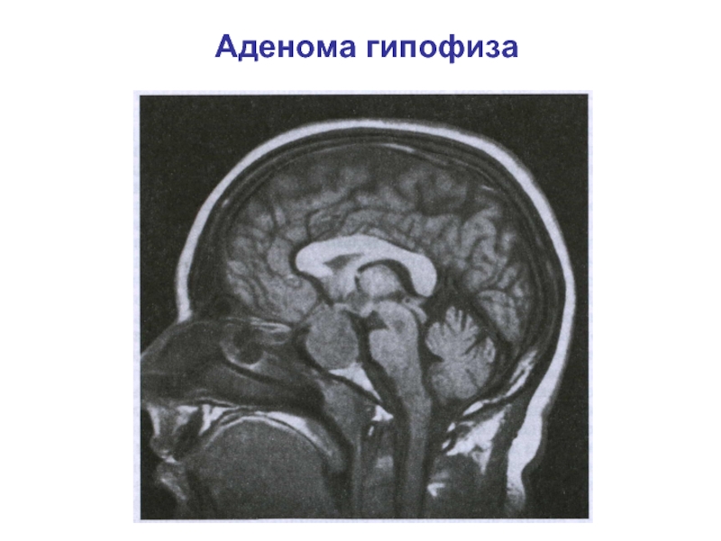 Объемное образование головного мозга мкб 10