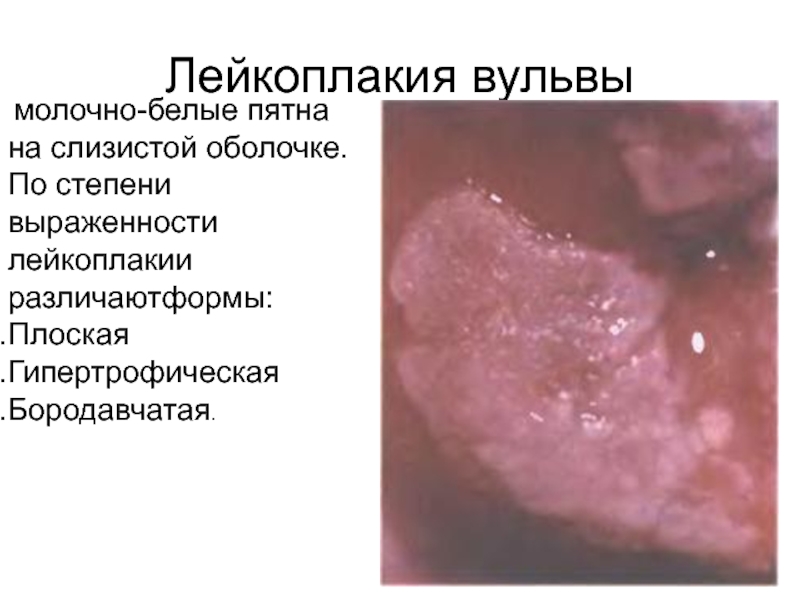 Доклад: Лечение дистрофических заболеваний вульвы