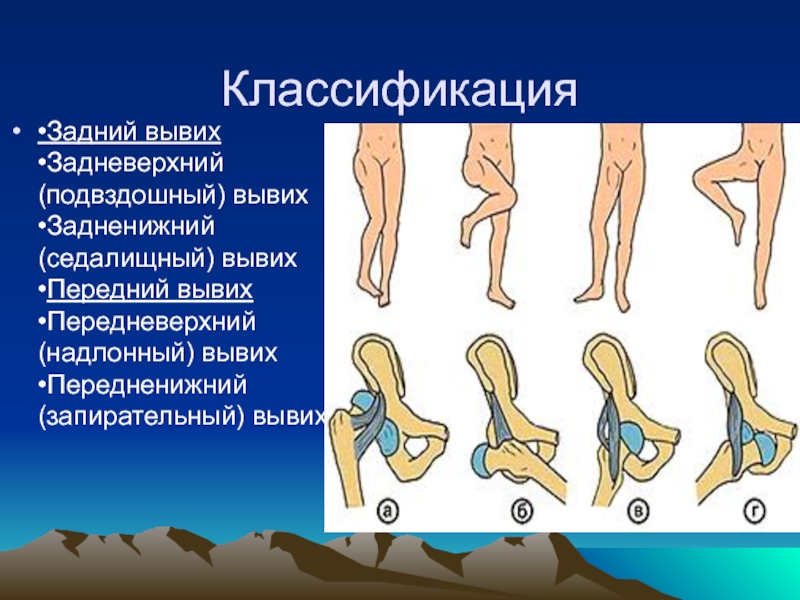 Вывих бедра презентация