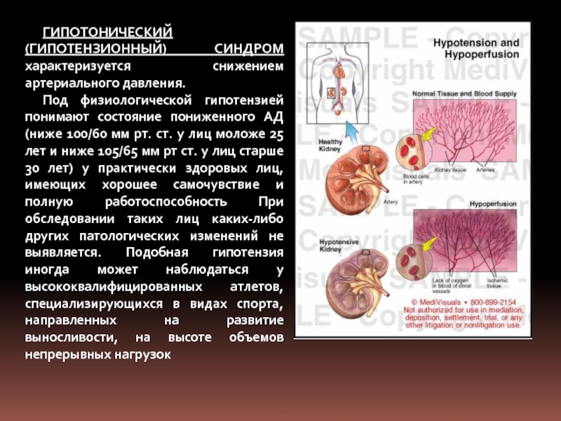 Гипотоническая болезнь презентация