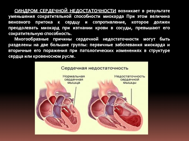 Наиболее частая причина сердечной недостаточности. ХСН классификация. Камеры сердца изгоняющие кровь в сосуды.