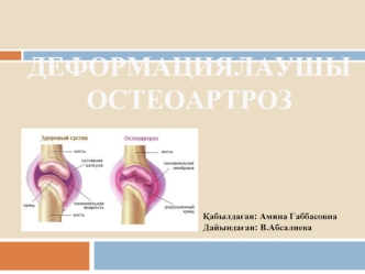 Деформациялаушы остеоартроз