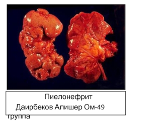 Морфология пиелонефрита и причины его возникновения