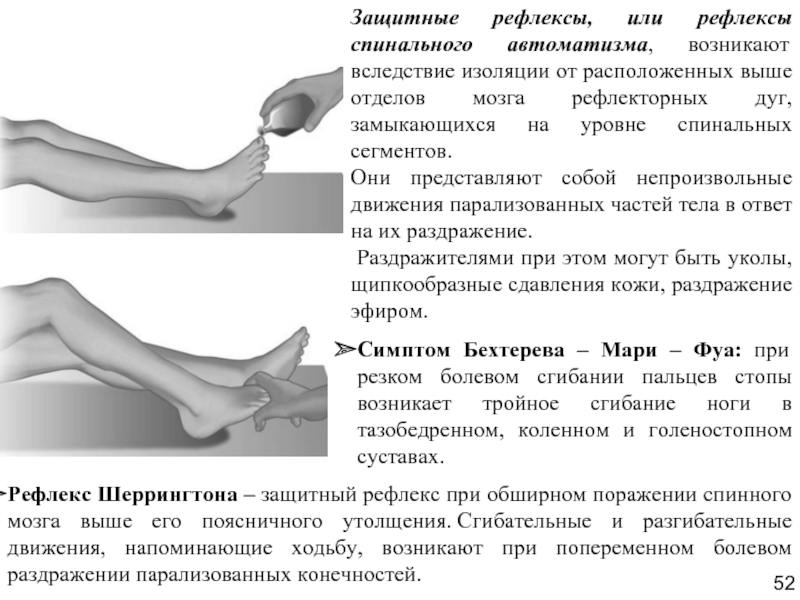 Рефлексы нижних конечностей. Симптом Бехтерева Мари фуа. Защитный рефлекс Бехтерева Мари фуа. Патологические пирамидные рефлексы, защитные спинальные рефлексы. Защитный (укоротительный) рефлекс Бехтерева-Мари-фуа.
