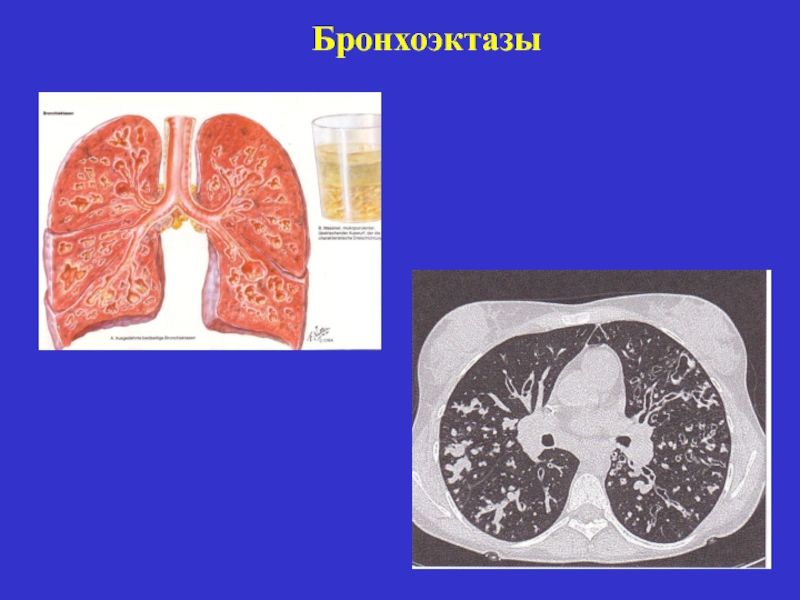 Бронхоэктазы нижней доли